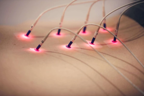 Laserneedle acupunctuur